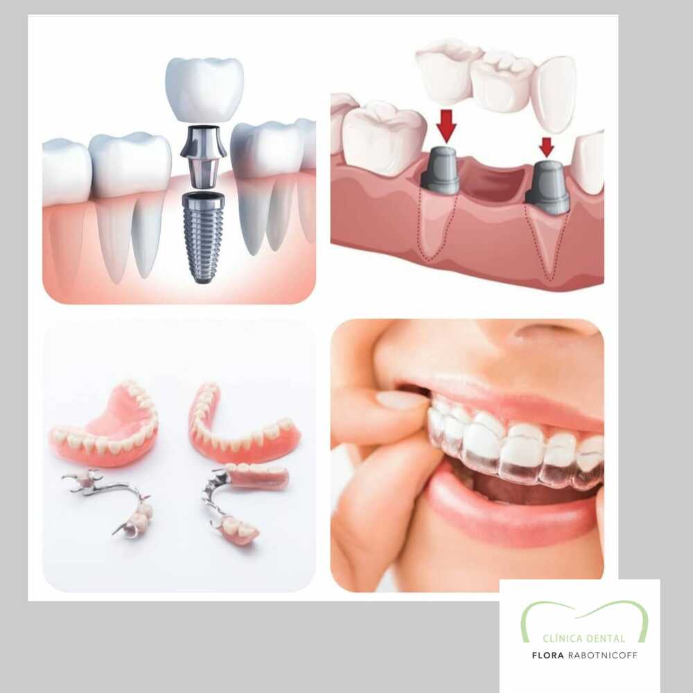 Implants dentals